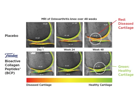 Cartilage Clinical Study